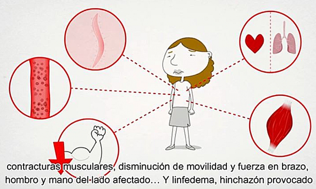 Los fisioterapeutas subrayan el impacto del ejercicio terapéutico en la mejora de la calidad de vida de las personas con cáncer de mama