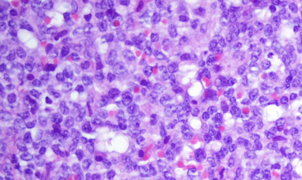Expertos en leucemia mieloide crónica piden a Sanidad ayuda con los registros epidemiológicos y facilidades para ensayos clínicos comerciales