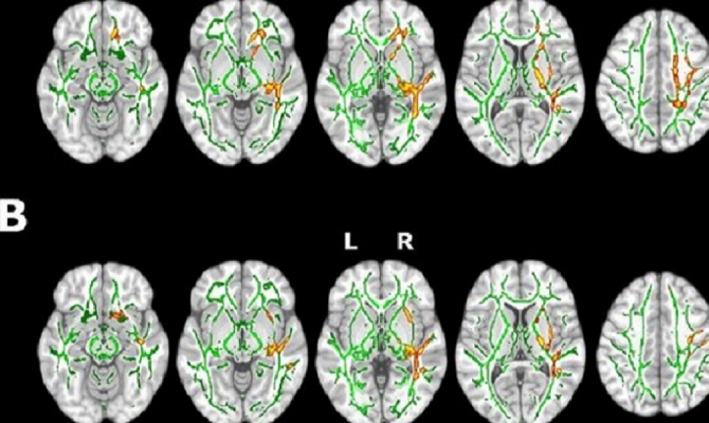 Hallan cambios en la estructura cerebral y la cognición de personas con insomnio