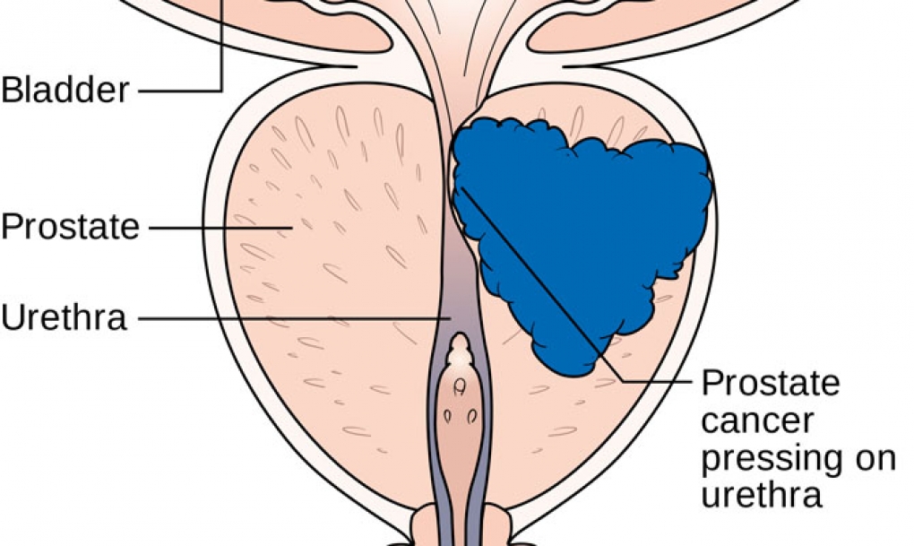 Un estudio cuestiona la eficacia del cribado del cáncer de próstata