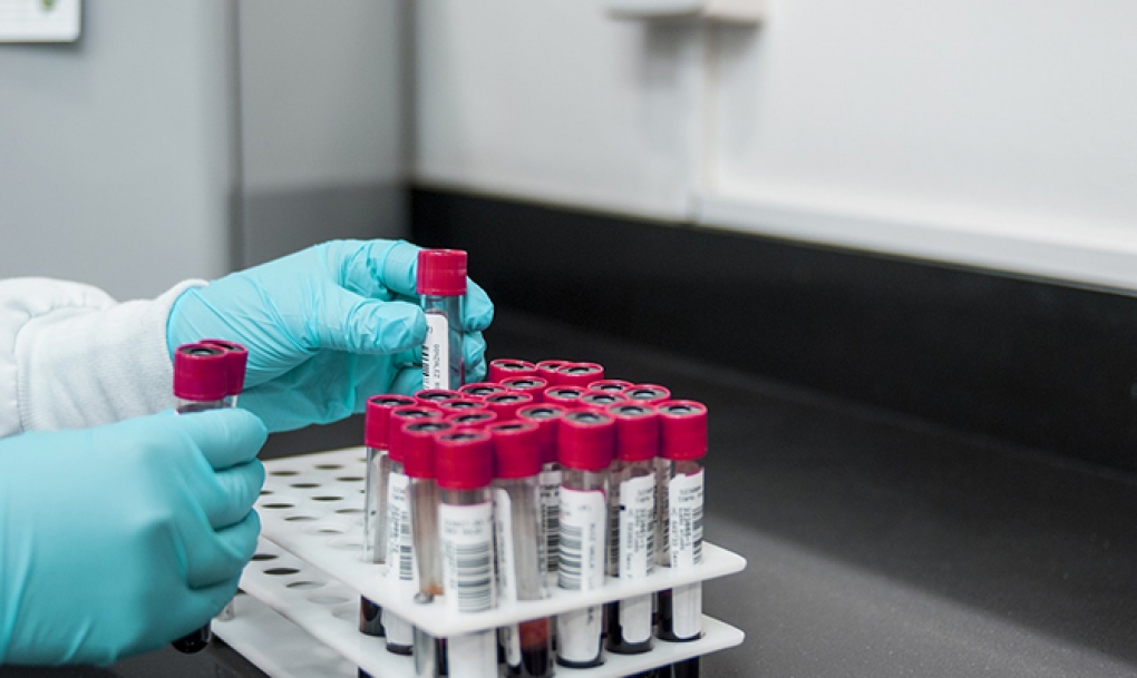 Diferencias epigenéticas en el ADN de las personas con VIH pueden afectar a su capacidad natural de controlar el virus