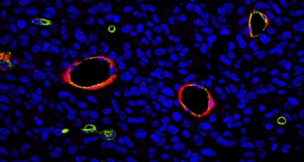 Una conexión entre los gliomas y las enfermedades neurodegenerativas abre la vía a nuevas terapias para este cáncer letal