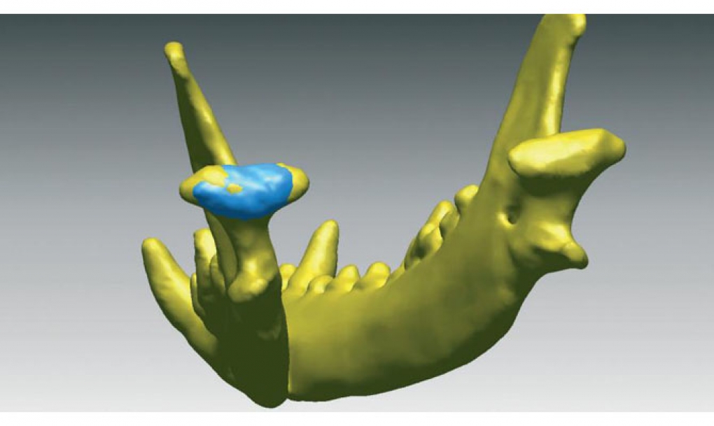 Investigan la impresión 3D para problemas maxilofaciales graves