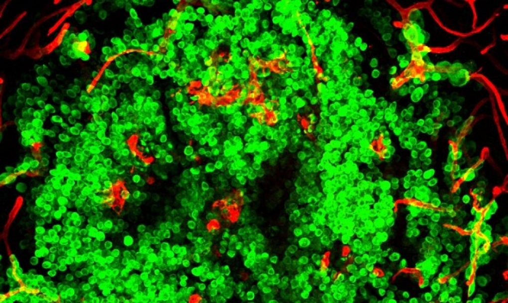 Plataforma internacional para agilizar la investigación en metástasis cerebral