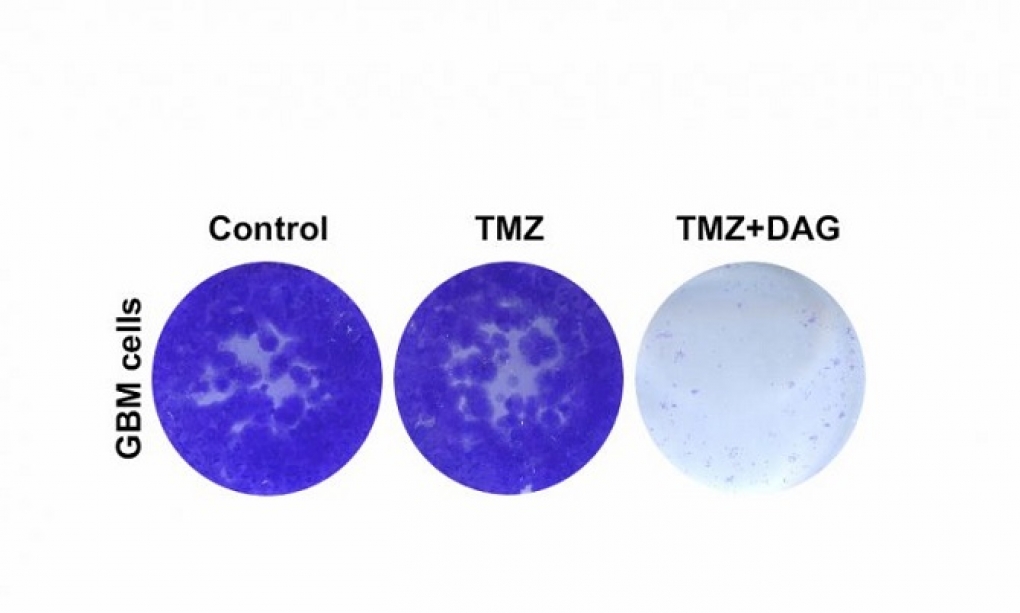 Nueva terapia combinada para mejorar la supervivencia de los pacientes con tumores cerebrales agresivos