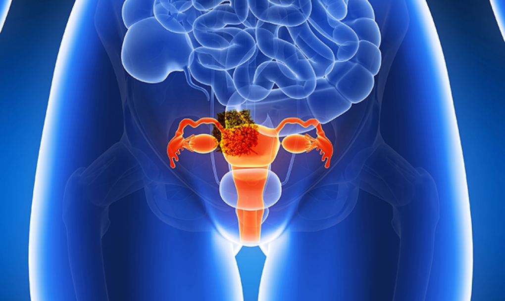 Los test de diagnóstico molecular de cáncer de cuello de útero llegarán a todas las mujeres de entre 35 y 65 años