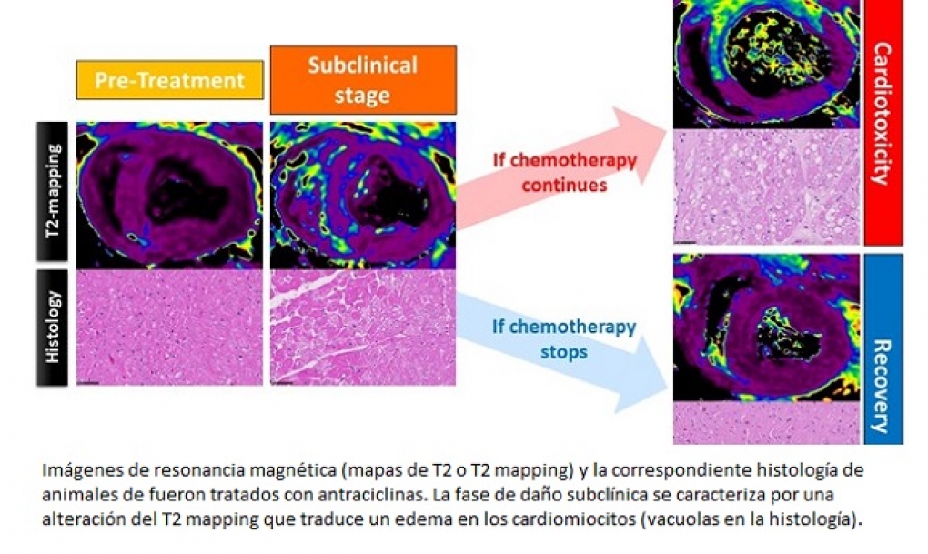 Hallan un marcador muy precoz de daño cardiaco asociado a fármacos del cáncer