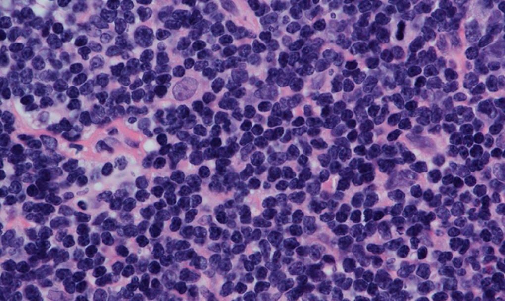 Descifran las causas moleculares que determinan la evolución del linfoma