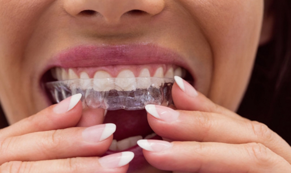 Los dentistas advierten de los peligros de adquirir por internet productos sanitarios como ortodoncias y blanqueamientos dentales