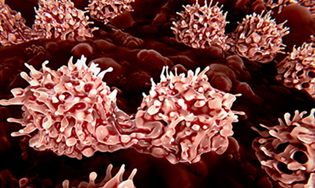 Hematólogos y pacientes con neoplasias mieloproliferativas subrayan la importancia de mantener un control activo de estas enfermedades de la sangre