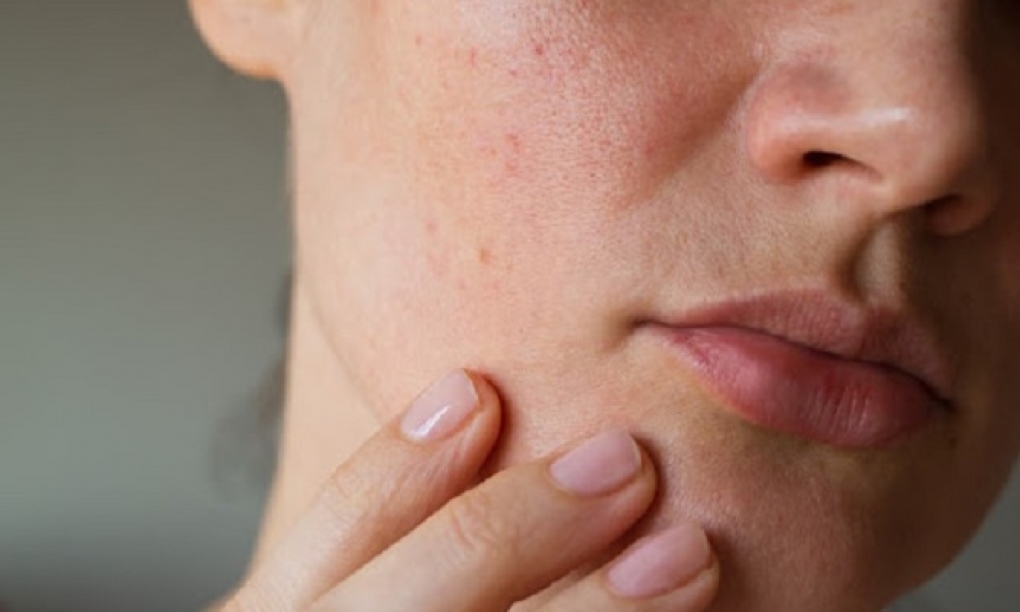Alimentos que deberías evitar si tienes psoriasis