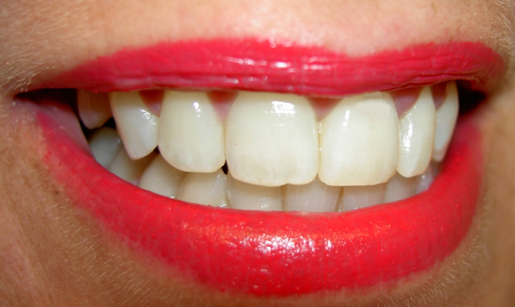 El Consejo General de Dentistas denuncia la venta ilegal del blanqueante dental White Light Smile a pacientes