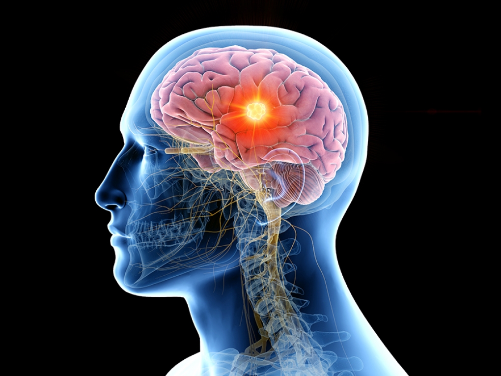 Una terapia experimental logra eliminar un tumor cerebral incurable