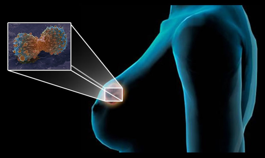 Nueva técnica de microondas para una detección más precoz del cáncer de mama