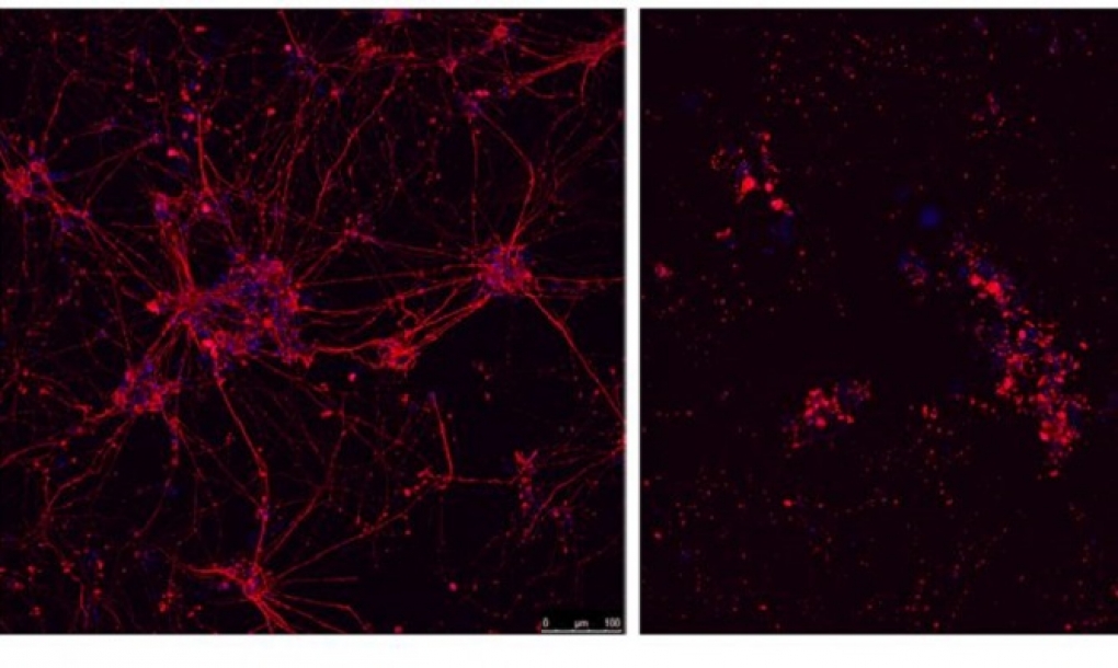 Investigadores del CNIO descubren la causa de la muerte neuronal en gran parte de los pacientes con ELA