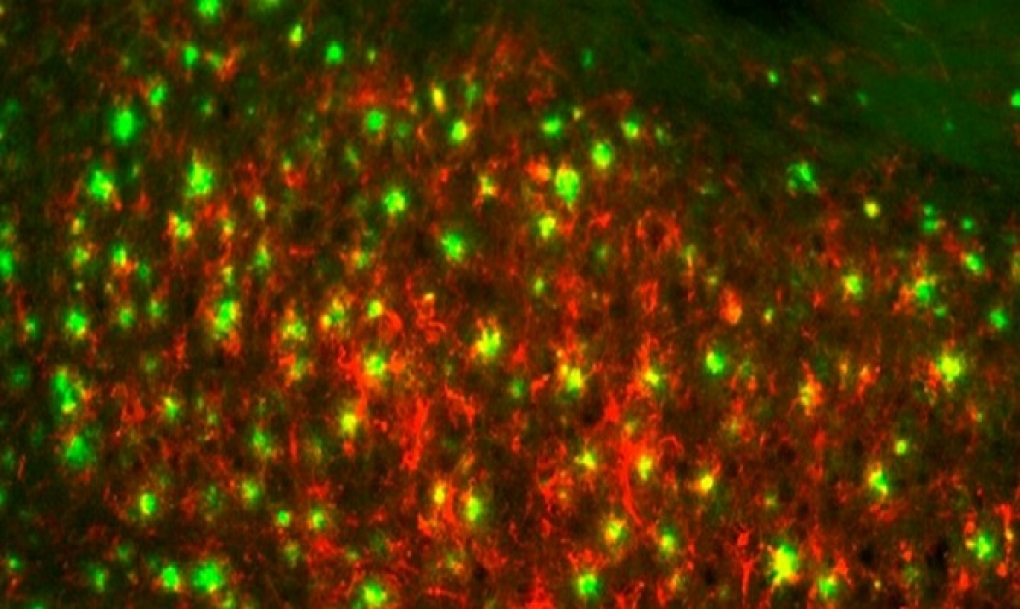 Nanopartículas para detectar Alzheimer con resonancia magnética