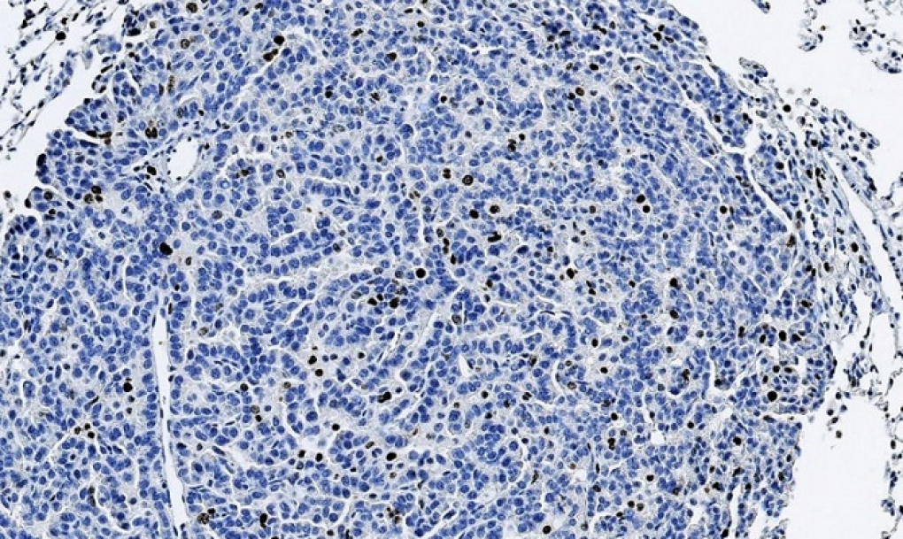 La inhibición de la proteína p38 reduce el crecimiento de tumores de pulmón