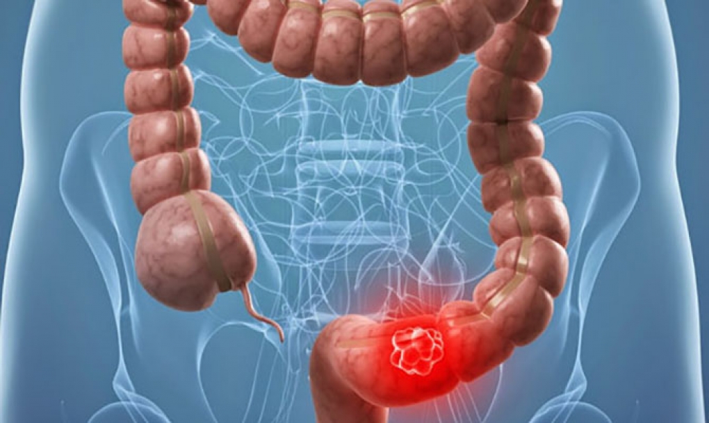 El cáncer de colon se puede curar en el 90% de los casos si se detecta precozmente