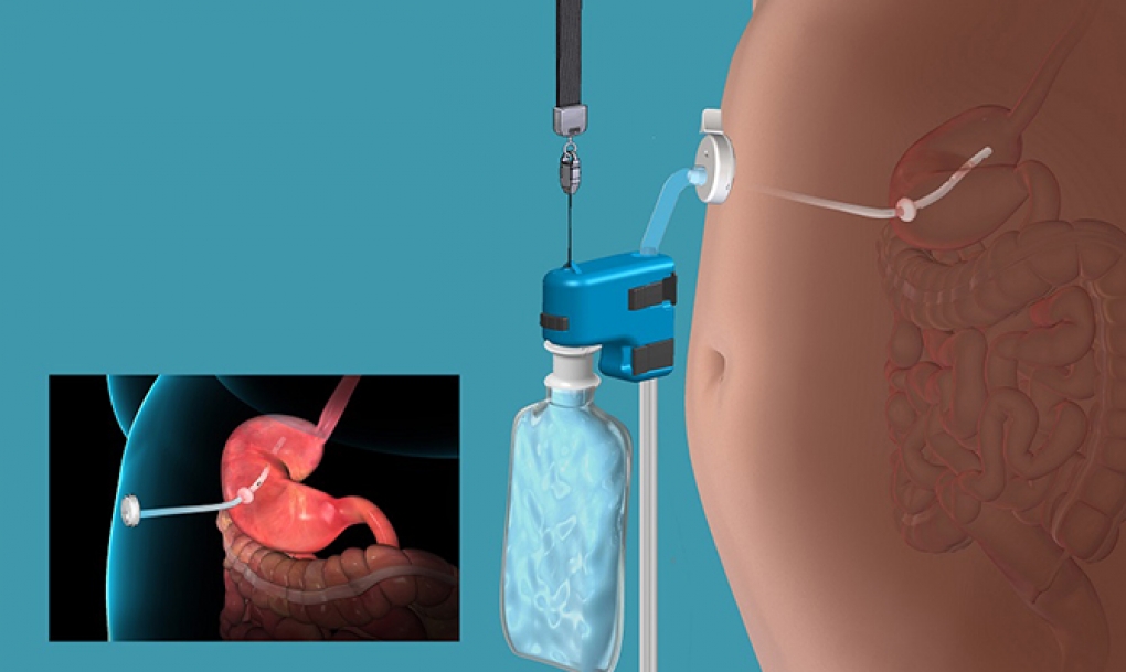 La FDA aprueba el Bypass Externo, la válvula que permite tratar la obesidad grave sin cirugía
