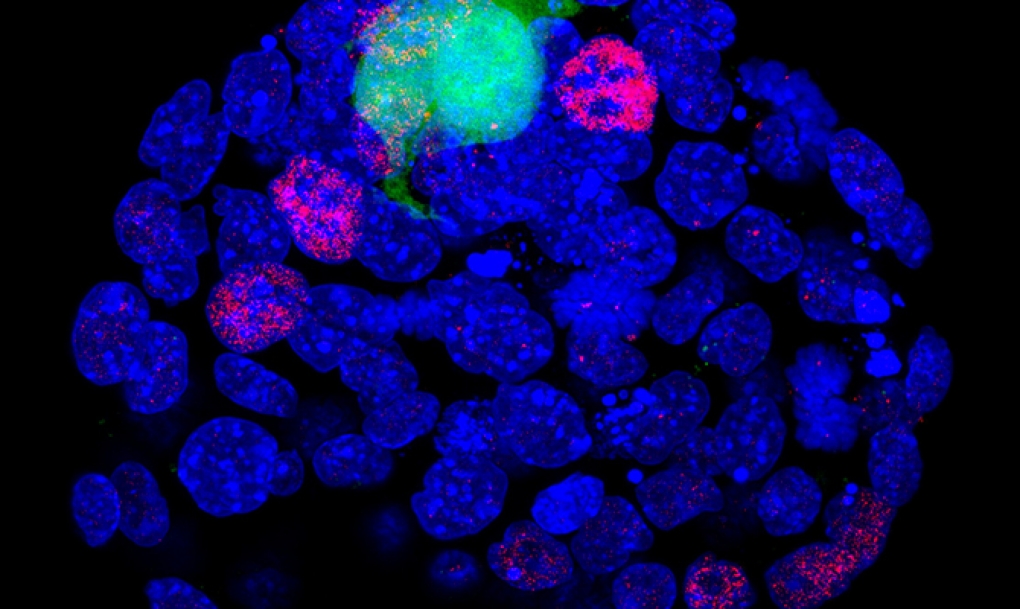 Células madre pluripotentes, posible terapia contra el alzheimer, el parkinson y el infarto cerebral