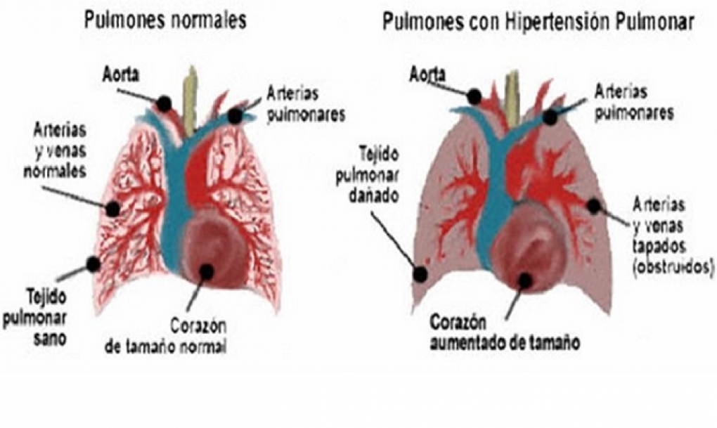 Identifican una región en el genoma implicada en el desarrollo de la hipertensión pulmonar hereditaria