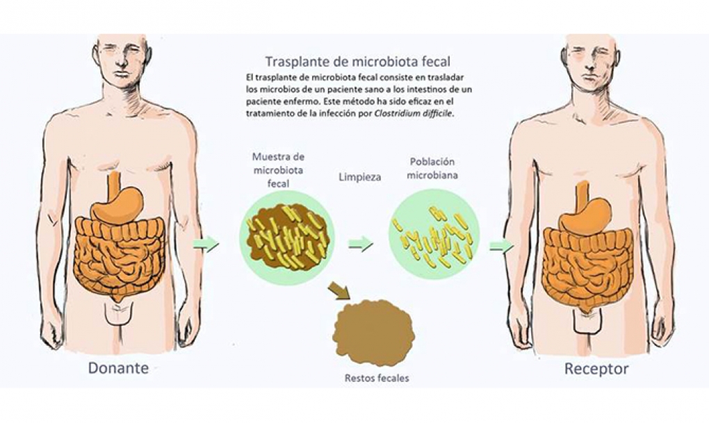 Una nueva técnica mejora la eficacia del trasplante de microbiota fecal intestinal