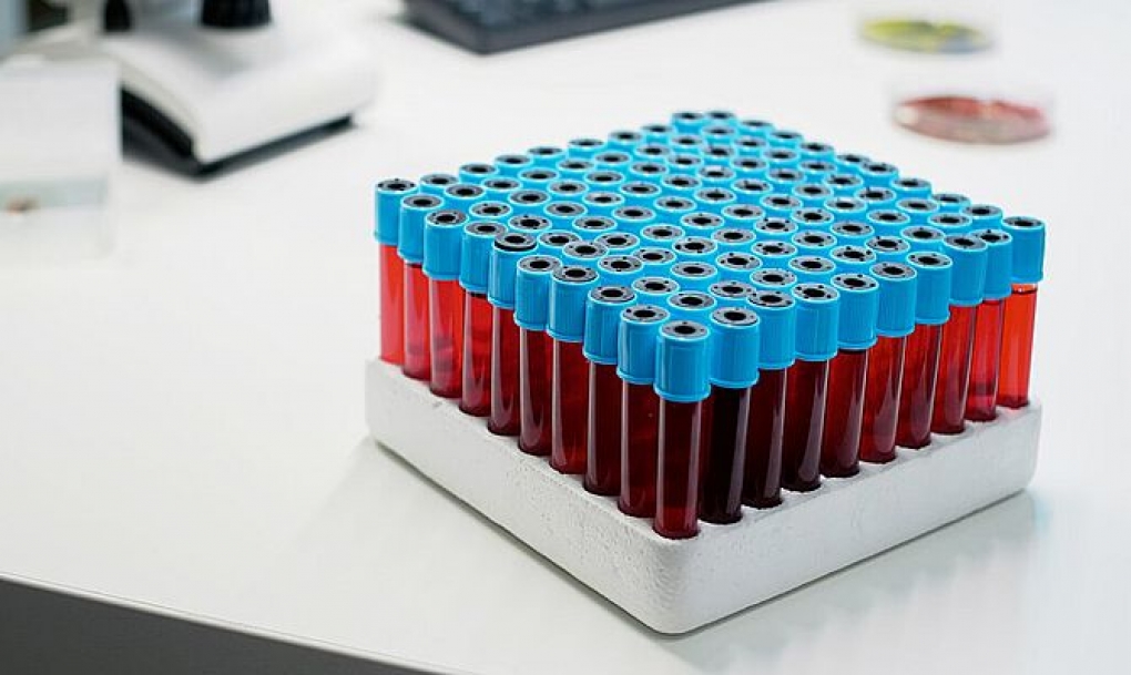 Un indicador disfunción endotelial permite predecir la necesidad de traslado a UCI en pacientes con trasplante de médula