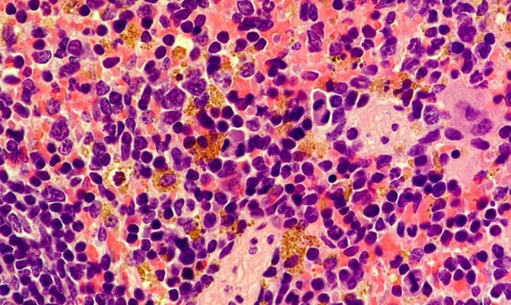 El CNIO descubre la relación entre una anemia poco frecuente y el cáncer