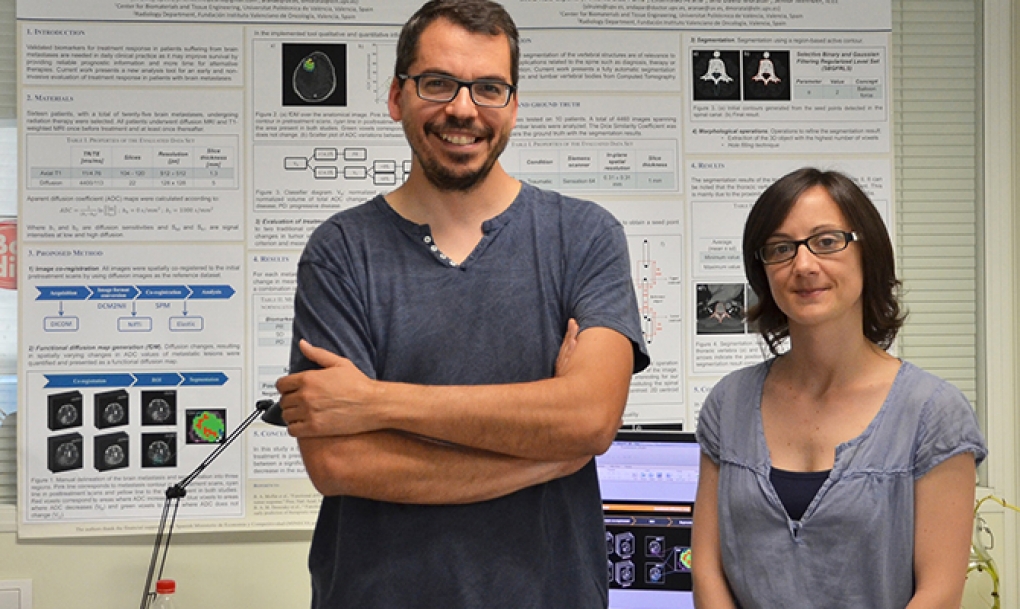 Un nuevo biomarcador permite predecir la respuesta al tratamiento en pacientes con tumores cerebrales