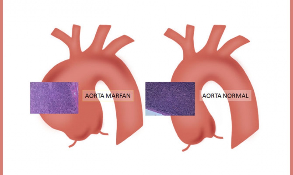 Explican la causa de la rigidez de la aorta en el síndrome de Marfan