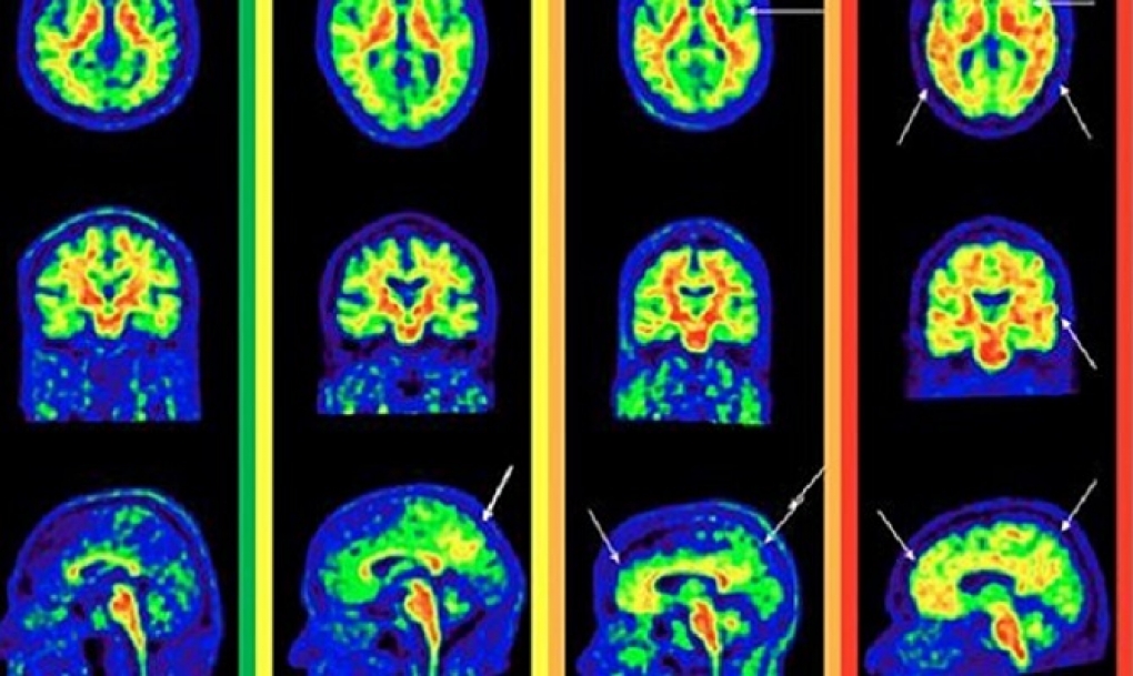 Investigadores europeos mejoran la sensibilidad del diagnóstico de las fases iniciales del alzhéimer