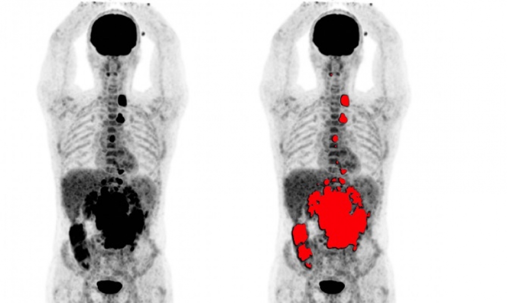 Proyecto para desarrollar un escáner PET de cuerpo entero y con mayor sensibilidad