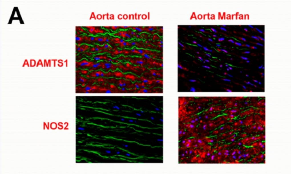 La inhibición de una proteína, clave en el síndrome de Marfan y otros aneurismas
