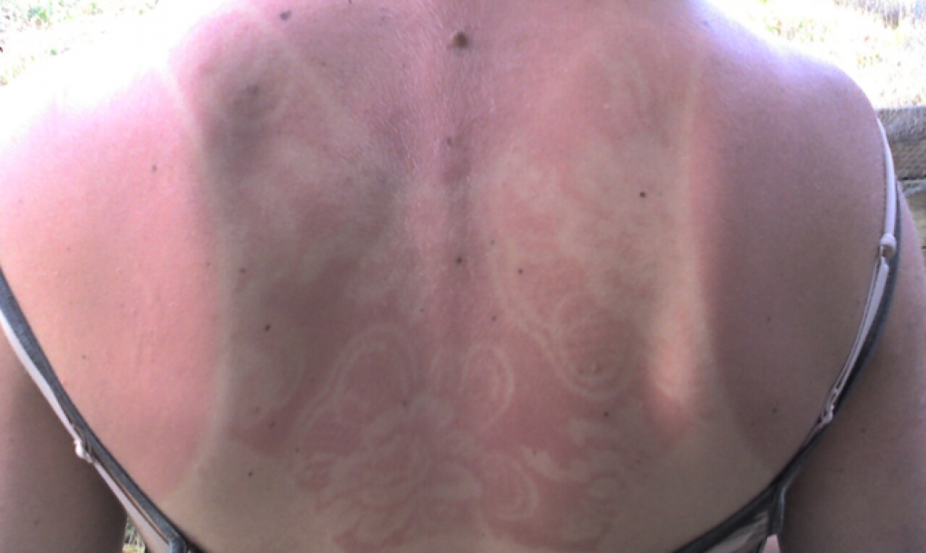 Los dermatólogos recuerdan que la nueva moda de tatuarse la piel al sol puede causar daños irreparable en la piel