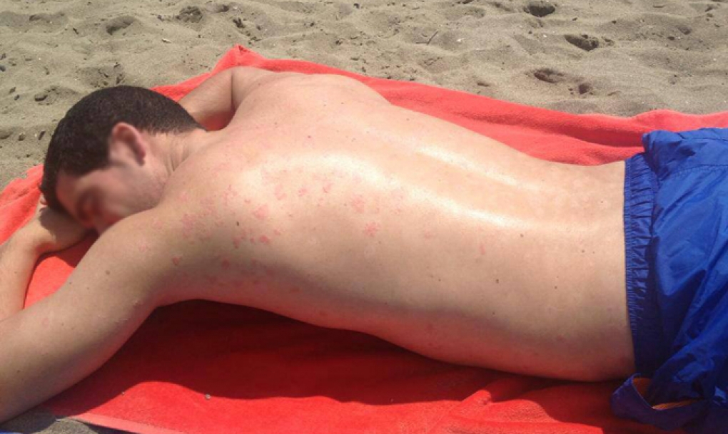 La psoriasis mejora en verano gracias al sol, pero «también existen riesgos»