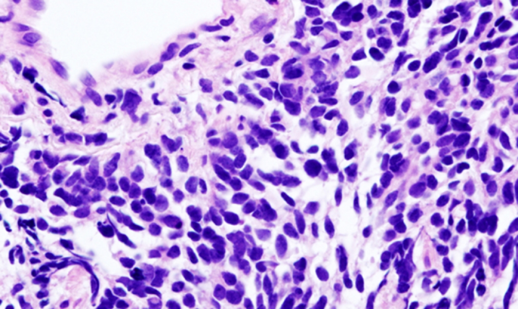 El aliento sirve para detectar cáncer de pulmón