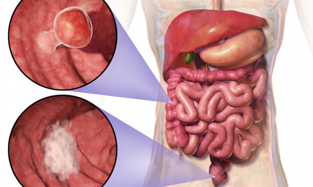 Los oncólogos piden ampliar el cribado del cáncer de colon para detectar a tiempo este tumor