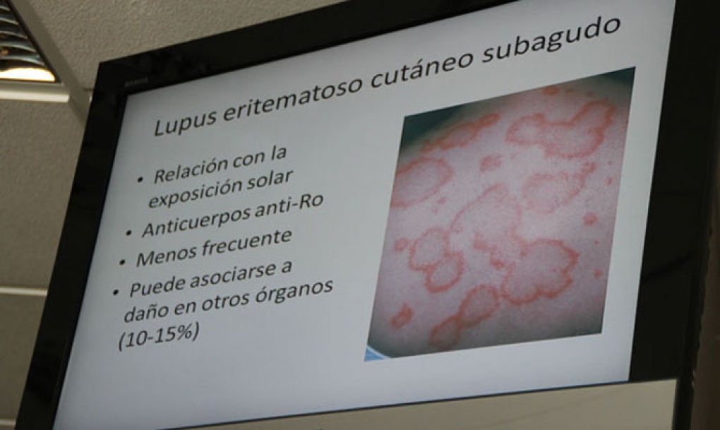La prevalencia del lupus ha aumentado en la población española durante los últimos años