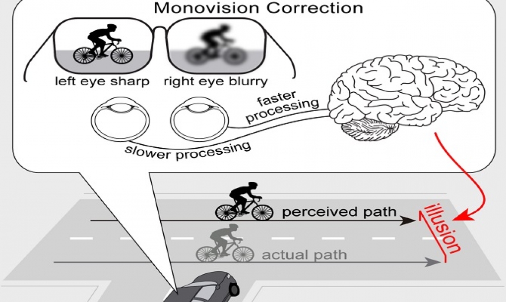 La monovisión, aunque compensa la vista cansada, altera la percepción de la distancia para objetos en movimiento