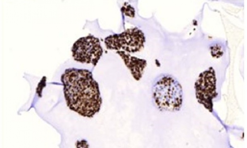 Un estudio abre nuevas vías terapéuticas para el tumor extracraneal más frecuente en niños