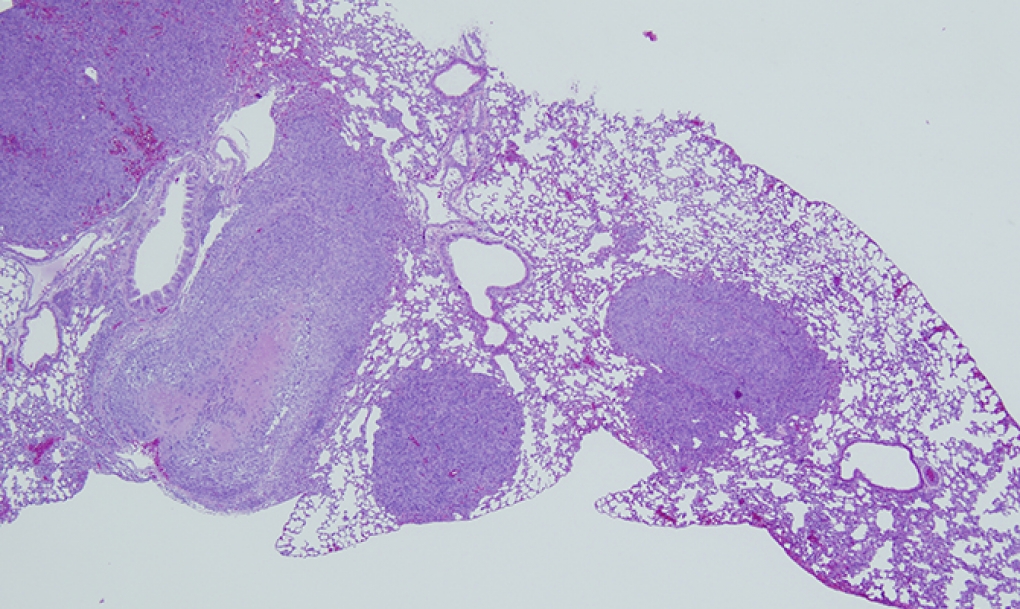 La Inmuno-Oncología ofrece resultados en uno de los carcinomas de pulmón más prevalente en España