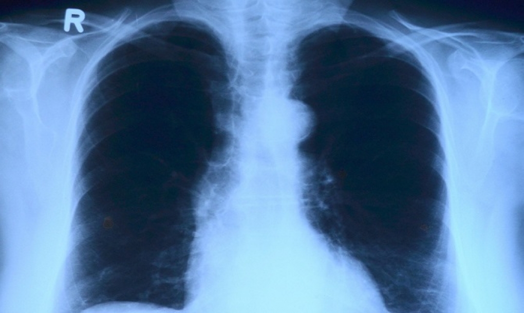 Nuevo sistema de radiografía de alta precisión para valorar la afectación pulmonar en pacientes con coronavirus