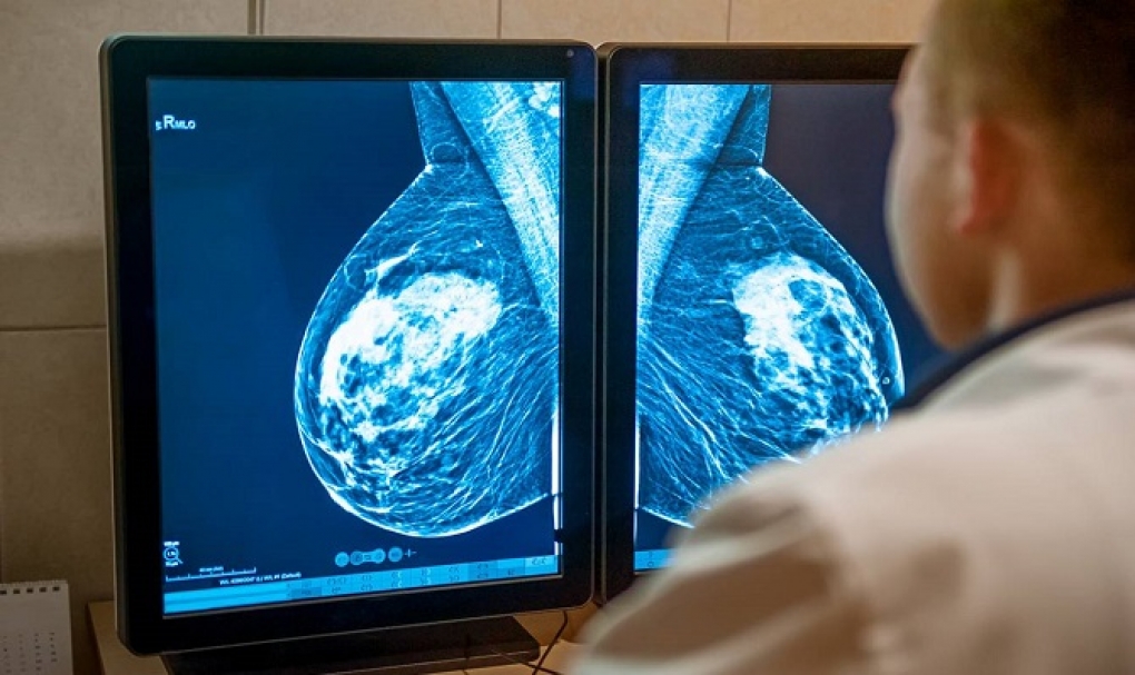 Algunas mujeres con cáncer de mama podrán evitar la quimioterapia
