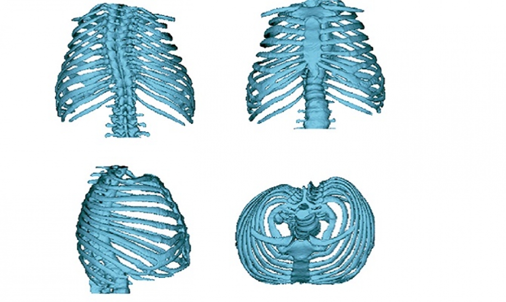 Descrita la asociación entre la forma de las costillas y la función pulmonar en pacientes con huesos de cristal