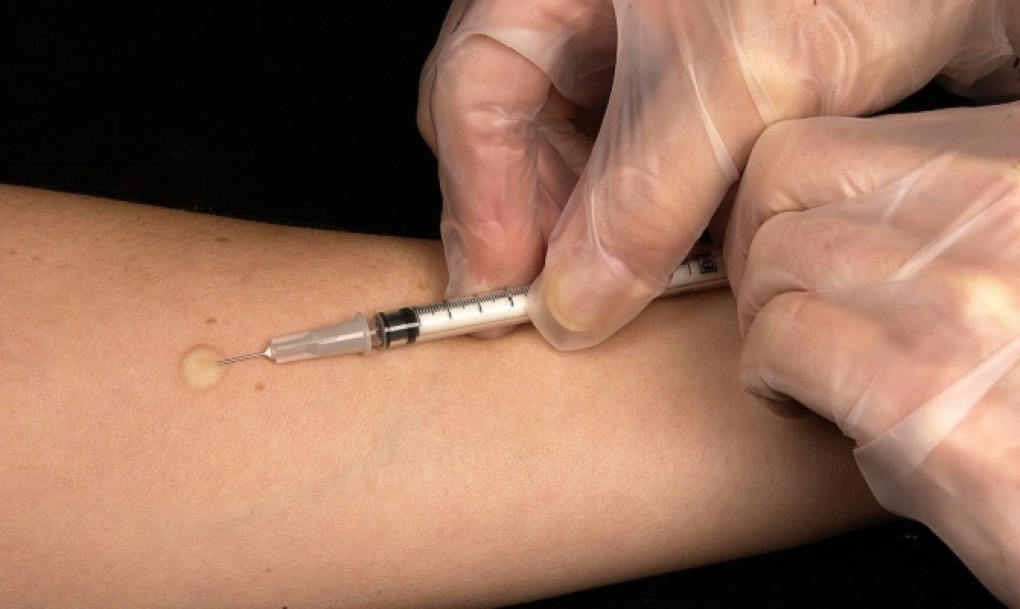 España registra más de 4.000 casos de tuberculosis al año, con una de las incidencias más altas de la Unión Europea