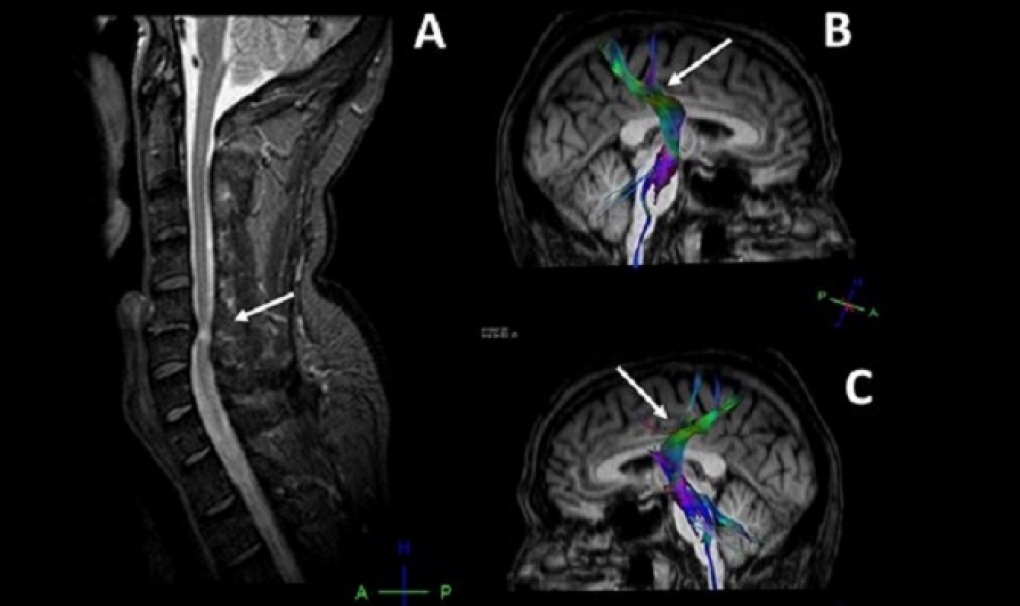 Detectan daño cerebral en pacientes con hernias cervicales mediante técnicas de neuroimagen e inteligencia artificial