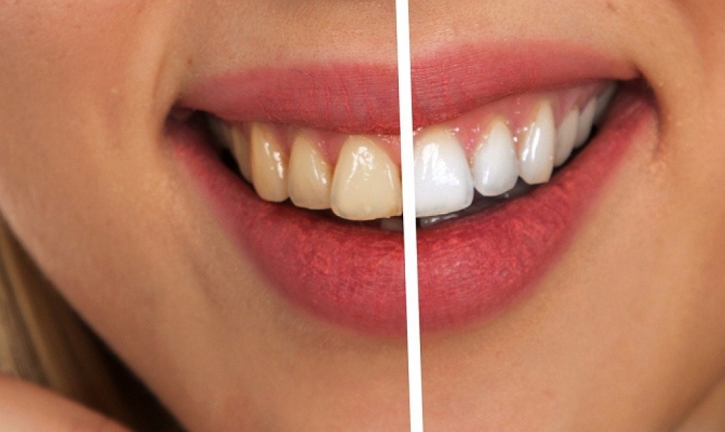 El blanqueamiento dental, precios y productos