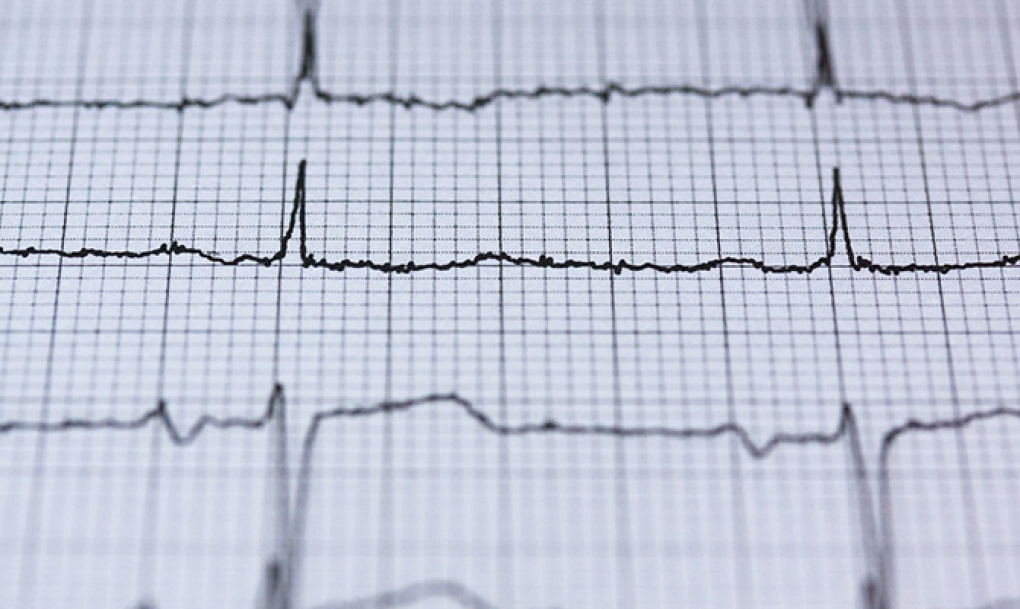 La mortalidad en los pacientes con diabetes que esperaban un procedimiento de cardiología intervencionista al comenzar la pandemia triplicó la de los no diabéticos