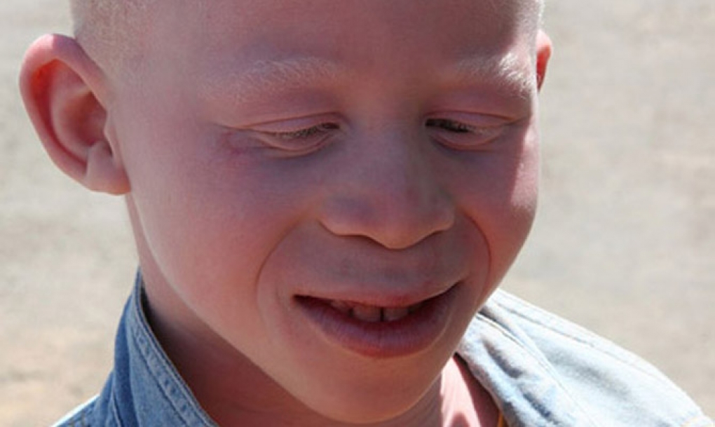 Las personas con albinismo tienen un riesgo alto de desarrollar cáncer de piel