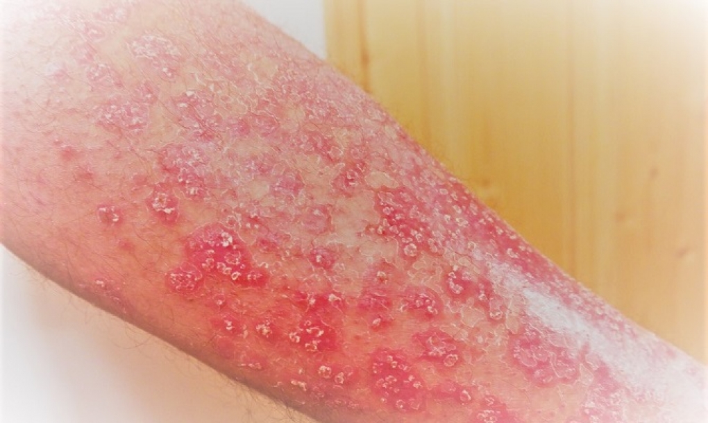 Nueva diana terapéutica contra la psoriasis